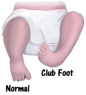 dennis brown for clubfoot - DB splint